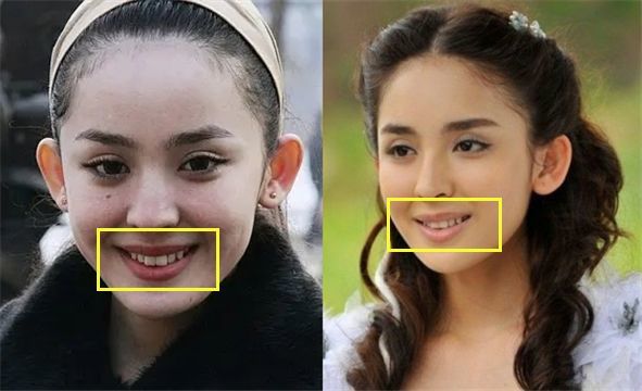 娜扎说话时嘴唇外翻,牙齿对嘴部形态影响