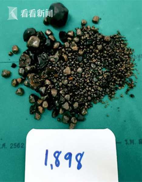 女子长期腹痛当便秘 手术取出1898颗结石 网友:胆囊里怎么装得下?