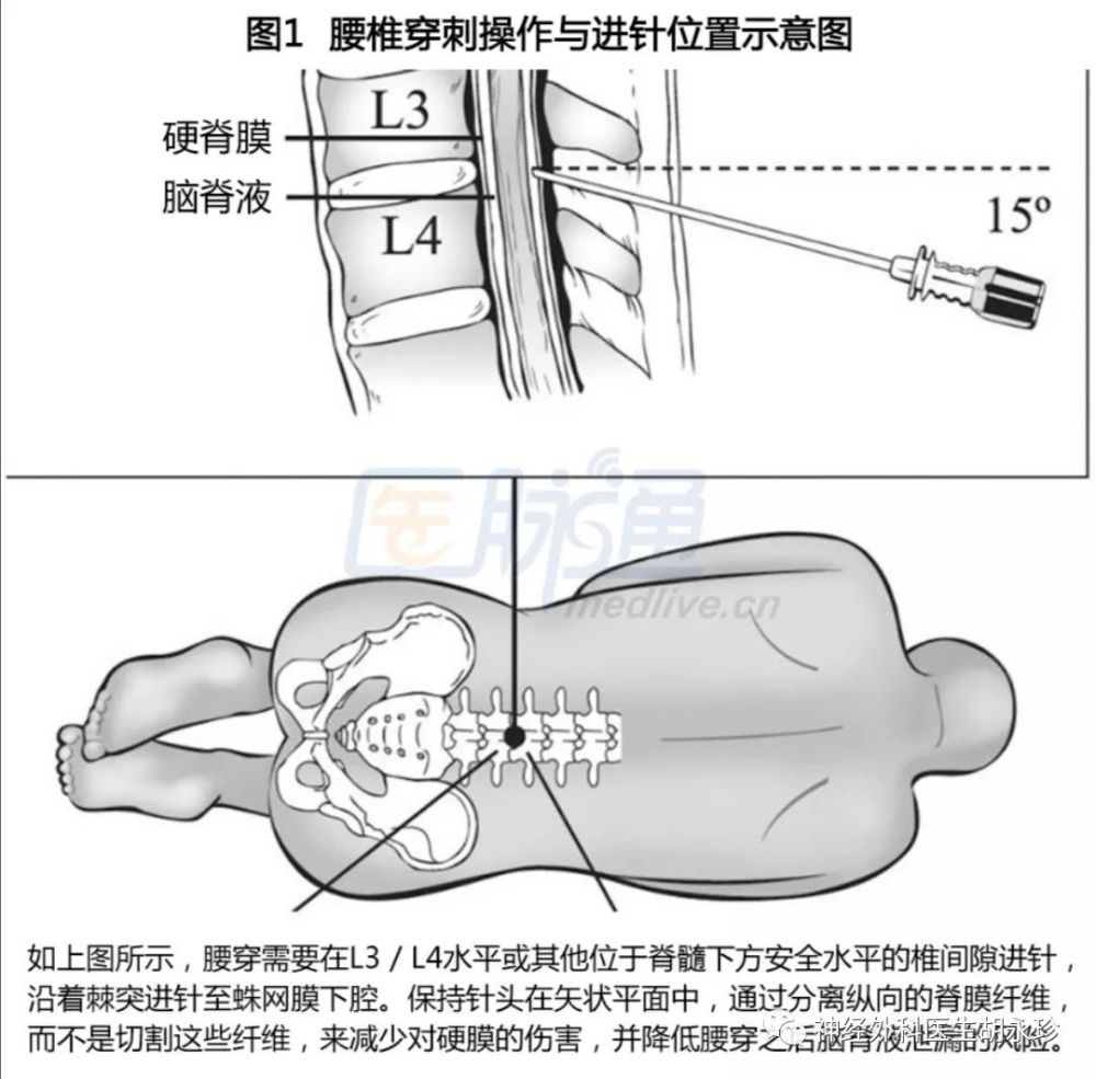 腰穿后主诉在认知恶化的患者中较不普遍.