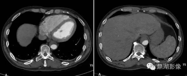 一些特別要注意的心血管ct影像徵象