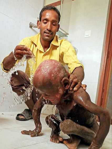 直击即将变成"石头"的印度11岁小男孩