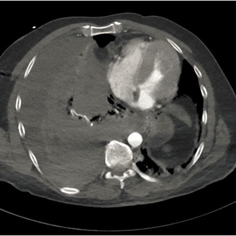 大量自发性血胸你见过吗│以影识病