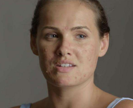 想知道自己是不是螨虫脸检查有无3大特征中1个都算