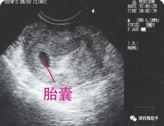 怀孕1 9个月 通过b超看胎儿慢慢长大的样子 真是太神奇了