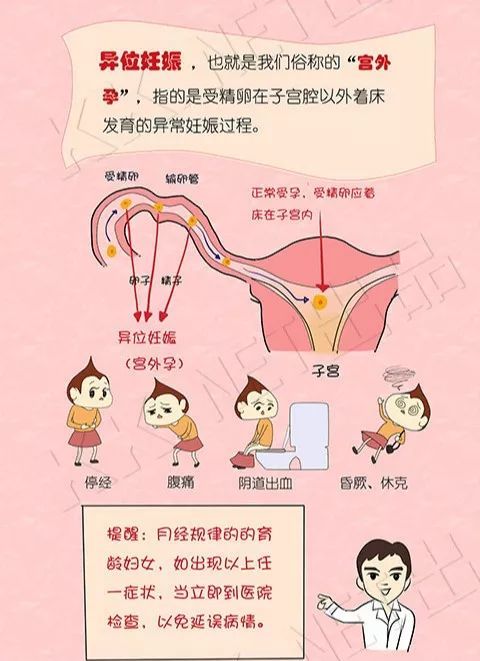 妇科医生手记 宫外孕 危险的异位妊娠