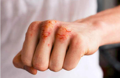 手痒得厉害怎么办 三个小妙招帮你快速止痒