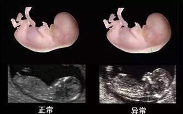 怀孕几个月胎儿四肢长全 这个阶段容易胎停 流产和畸形 别大意 腾讯新闻