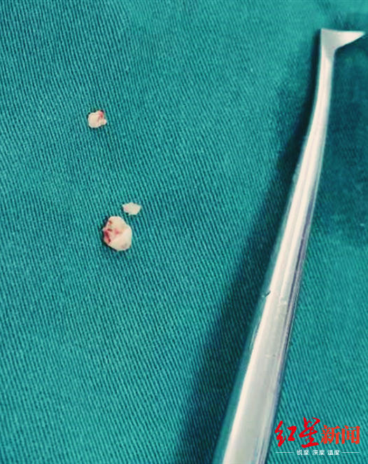 13岁男孩牙齿倒起长逆流而上差点冲进鼻子