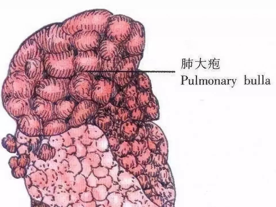 此时 肺大疱比较薄弱的地方发生破裂,出现微小孔洞,气体从这些"微创孔