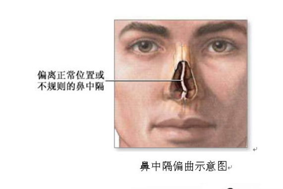 鼻中隔偏曲手术示意图.