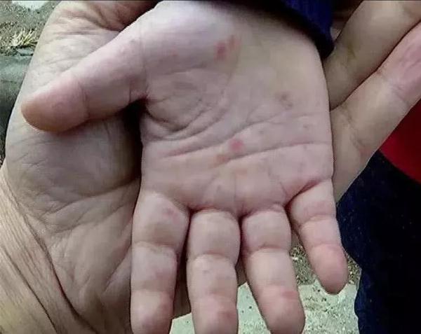 一个针眼大的东西每年都在夺走宝宝的命宝妈们,你还在无所谓