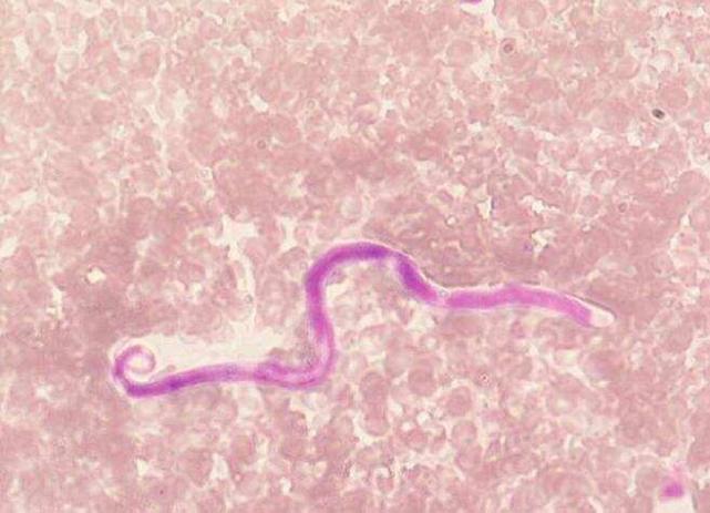 别以为是普通斑点,当心肚子里可能有寄生虫|寄生虫|蛔虫|蛲虫