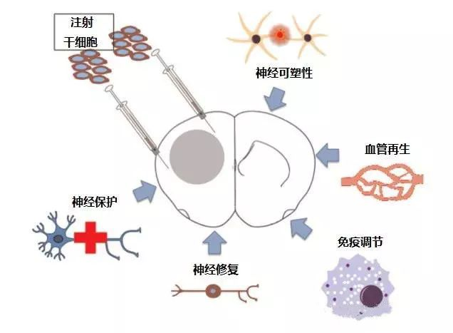 帕金森患者有救了 干细胞移植疗法效果感人 医学界的又一突破