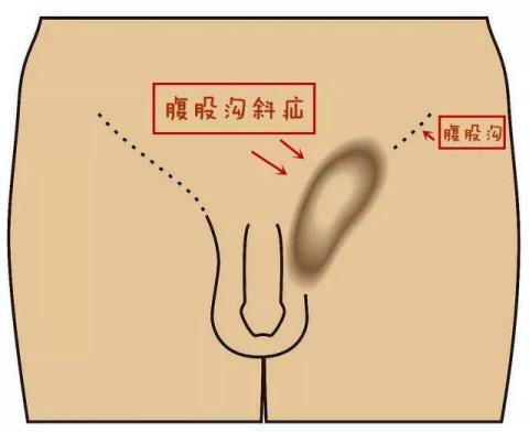 义乌天祥东方医院普外科团队,治疗小儿疝气经验是十分丰富的,甚至有