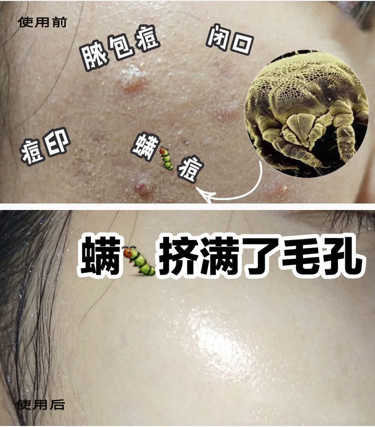 拒绝螨虫脸变态氨基酸洁面乳5秒揉一揉螨虫全出来了痘痘黑头全都没了