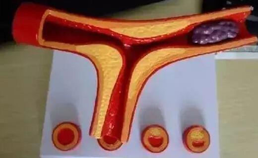 血管|脚上有一个化血栓的开关，没事做一做，能清理血管，预防血栓！