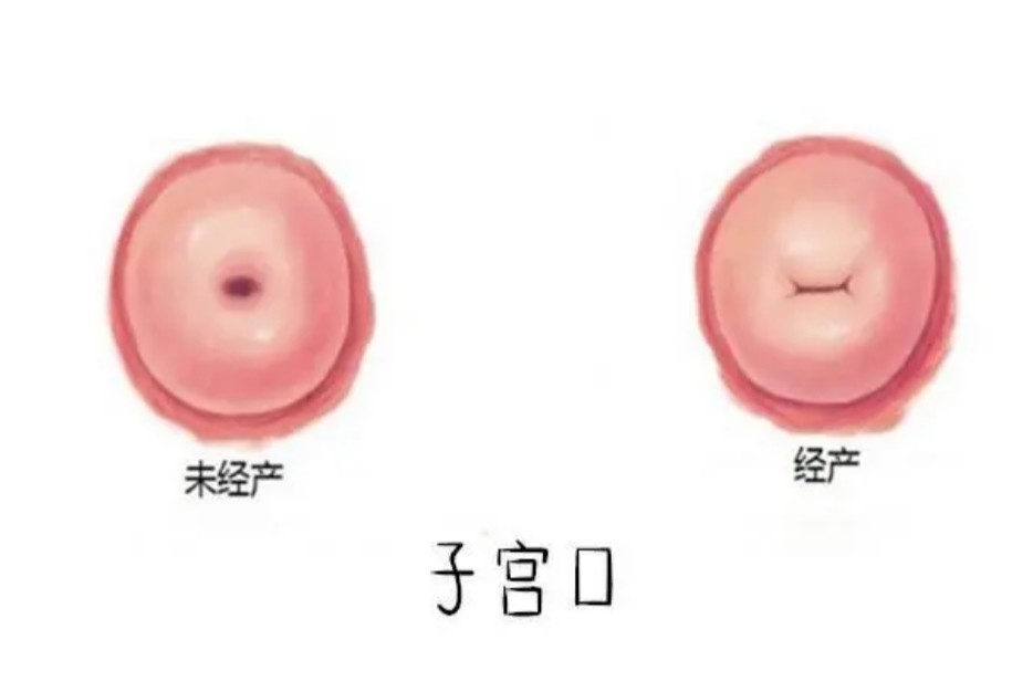 宫腔线清晰图片