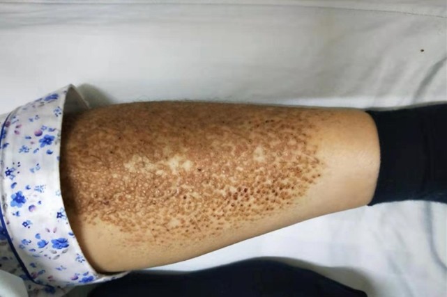 长沙一女子四肢长满小疙瘩57年来从未穿过裙子