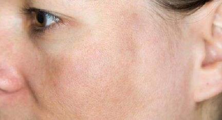 酱油吃多了 皮肤容易发黑 辟谣 黑色素沉淀 跟饮食几乎没关系