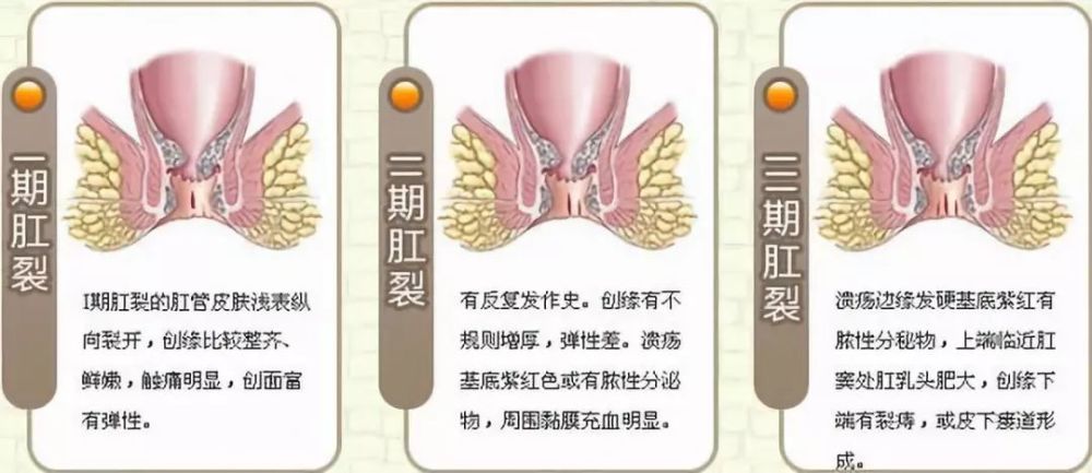 肛门有点痛,是否出现肛裂了?_腾讯新闻