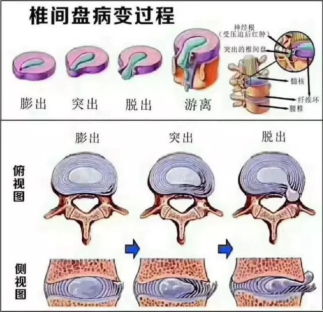 腰椎间盘突出症|腰椎间盘膨出、突出、脱出，都需要治疗吗？