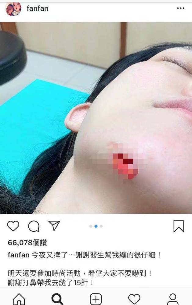 范玮琪摔倒撞伤下巴, 晒图超恐怖,网友:赶紧的,要不愈合了