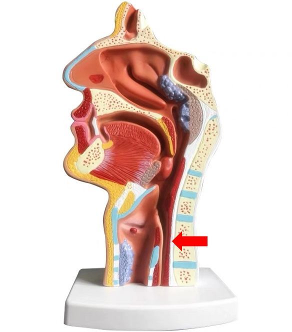 决定在超声 球囊 肌电图引导下为其开展环咽肌肉毒毒素注射技术