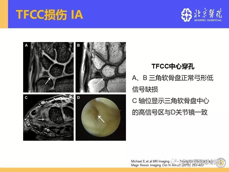 一文掌握三角纖維軟骨複合體tfcc損傷