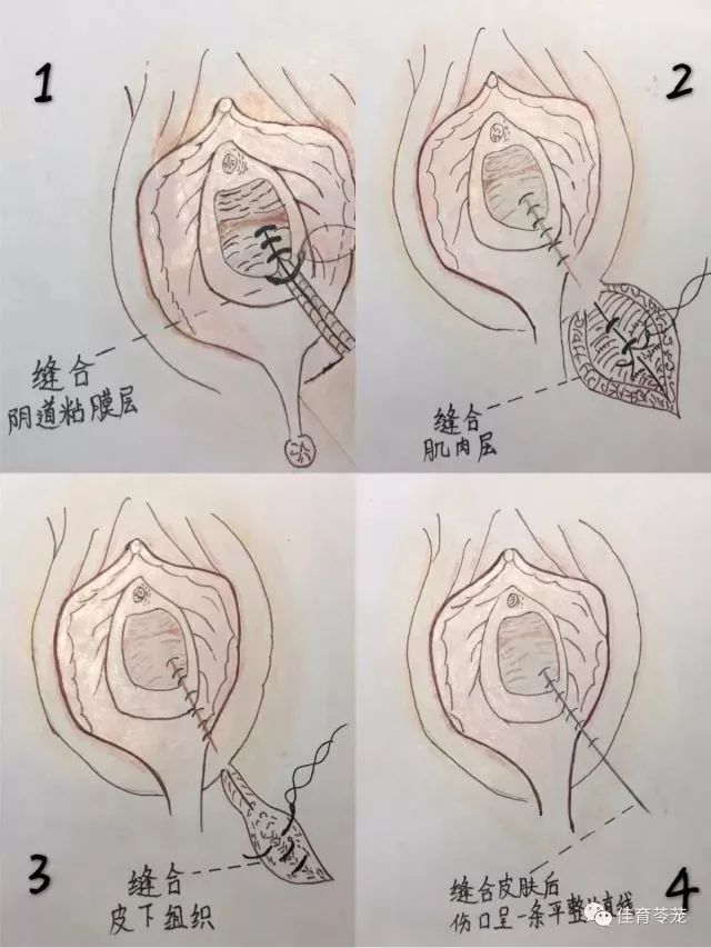 娃被抱错了咋办?会阴侧切是潜规则?30年