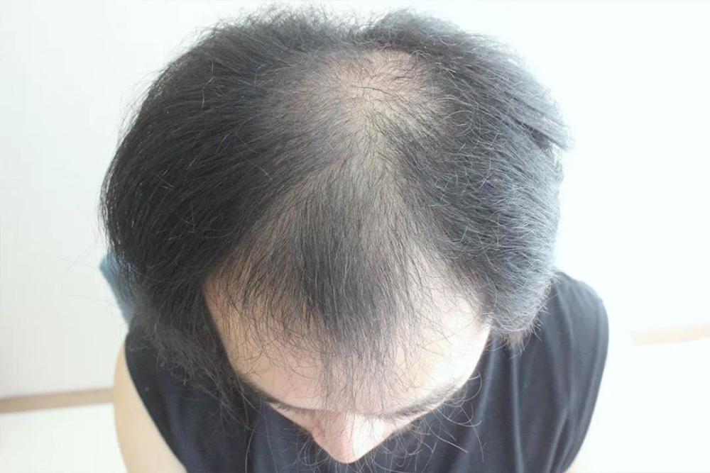 逐渐变粗变黑,直到恢复正常脂溢性脱发,又称男性型脱发,俗称秃顶多