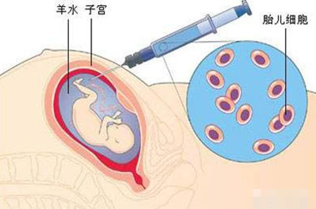 唐氏兒還常伴有先天性心臟病,消化道以及其他畸形,平均壽命還遠低於