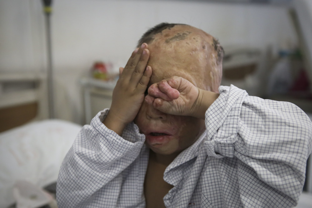 河北一5岁男孩因重度烧伤被喊像"怪物",母亲忍痛割皮救子