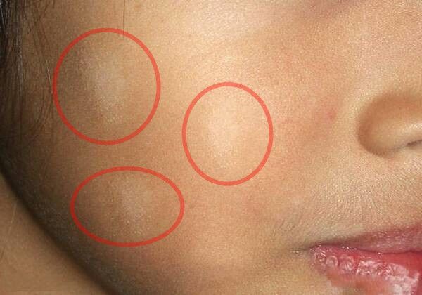 孩子脸上长白斑,家长吓坏了,这到底是什么?