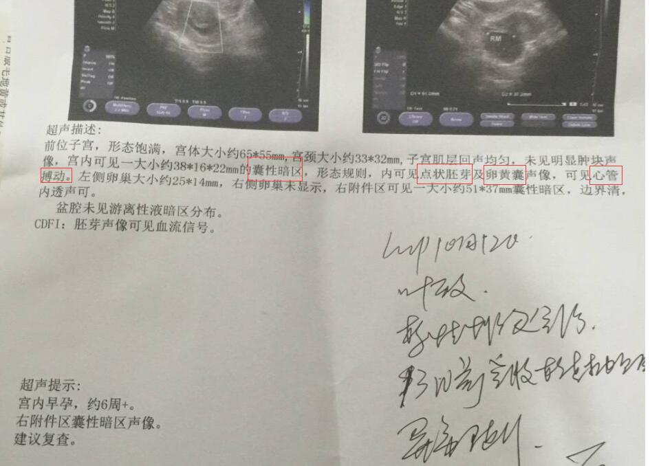 怀孕6周是个坎儿 准妈妈注意b超单上这4个数据 关系胎儿存亡