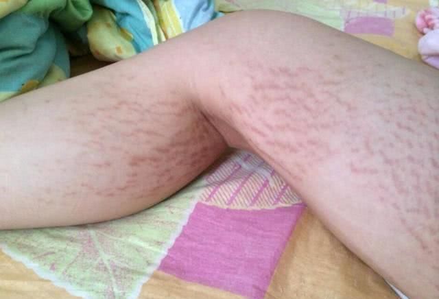 妊娠纹该如何预防才不会让自己后悔 孕后妊娠纹你要这样安全处理