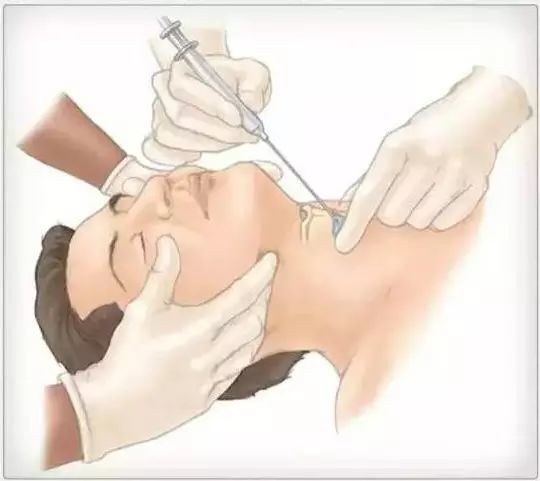 结肠镜检肠内营养路径腰穿前体表标记腰椎穿刺腰椎穿刺"腰硬联合麻醉"