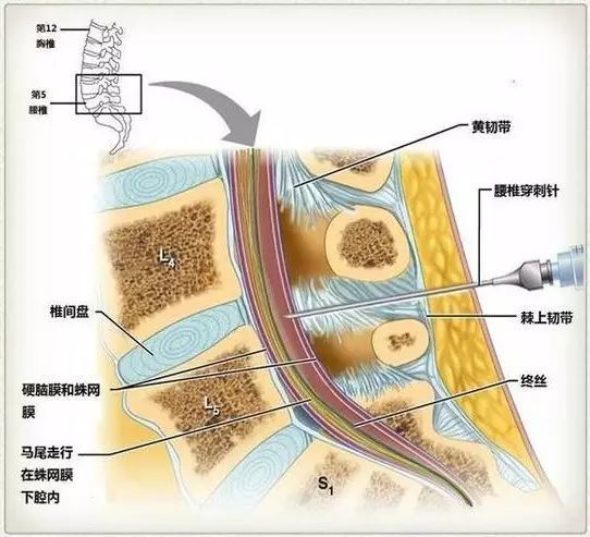 "腰硬联合麻醉"技术产科麻醉牵引术血液透析血液透析原理基因治疗每天