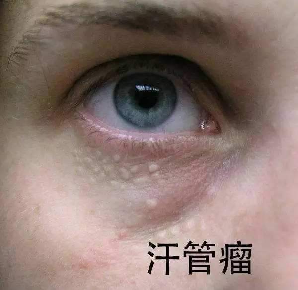 眼下脂肪粒怎么去除 可以预防吗