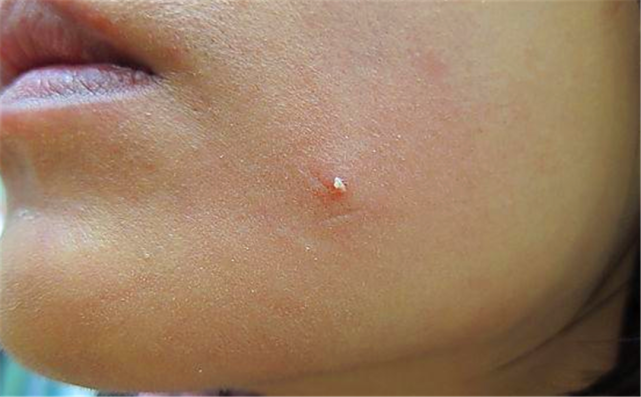 在挤痘痘时挤出来的"白色条状物"是什么东西?怎么去除?