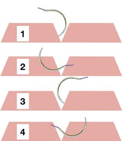 快试试棒球缝合法