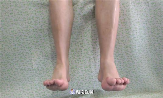 12岁少年患上高弓足 走起路来像 鸭子 很多家长却不了解