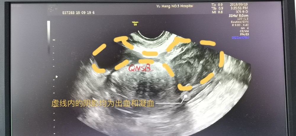 30岁女子腹痛呕吐 自认吃坏肚子拒做检查 结果肚里都是凝血块 腾讯新闻