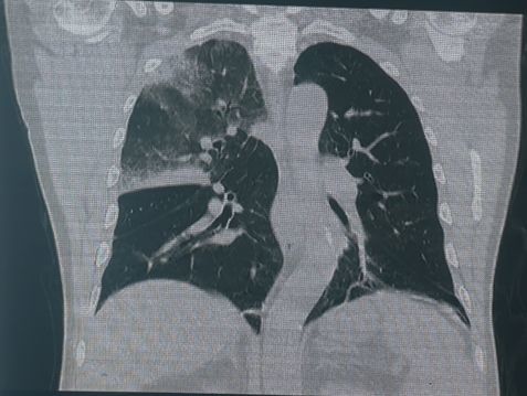 只需6步 搞定肺炎诊治大难题 腾讯新闻