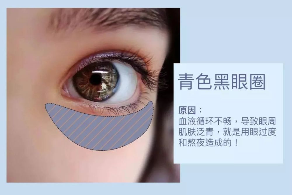 对于黑眼圈 你必须知道的几件事