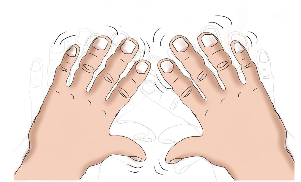 我们都知道帕金森病最明显的症状就是手脚不听使唤的抖动,这主要是