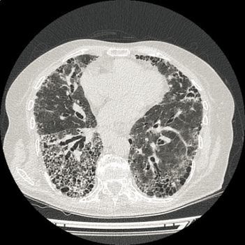 特發性肺纖維化1例丨以影識病