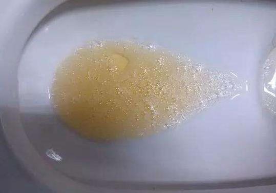 尿液出现这些情况,可能是身体出现了疾病问题,别不当回事!