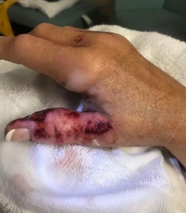 美国女子做美甲后染上噬肉菌差点失去整条胳膊