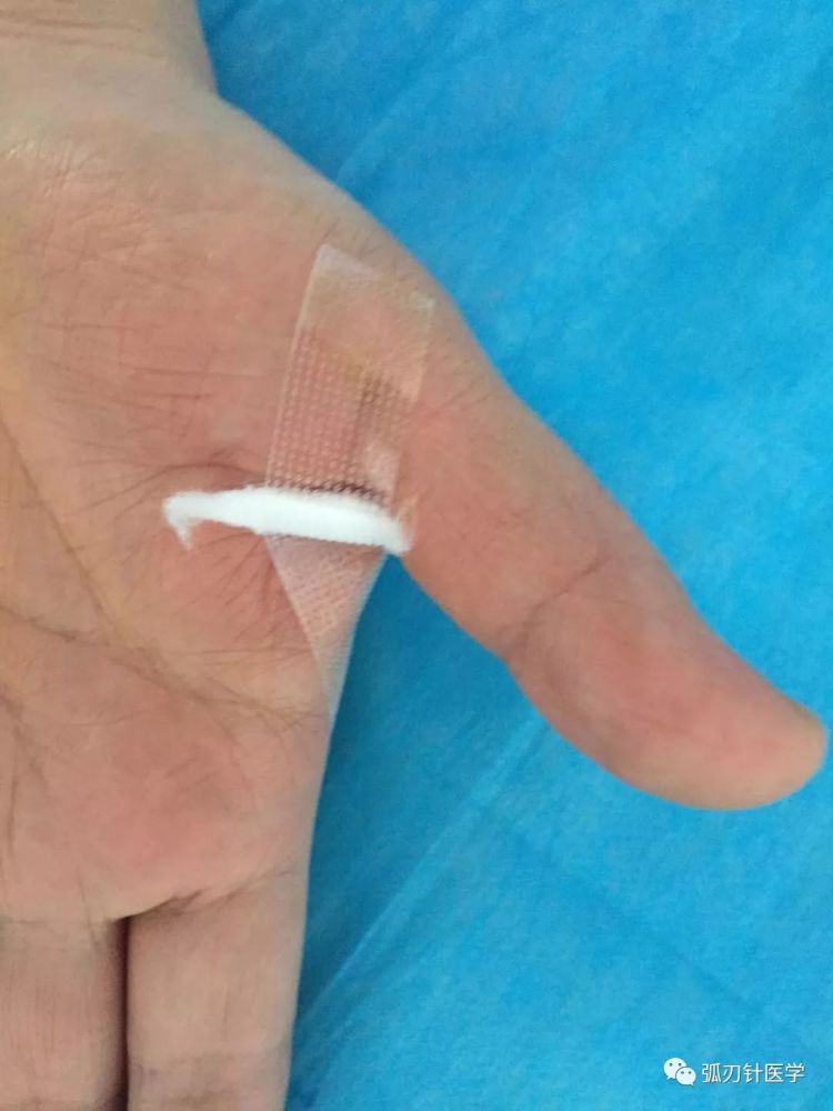 1支小针不到3分钟 郭好彩 腱鞘炎 手术不是必选项