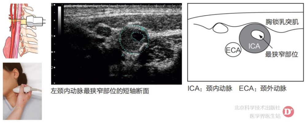 頸內動脈狹窄的超聲診斷,一文掌握